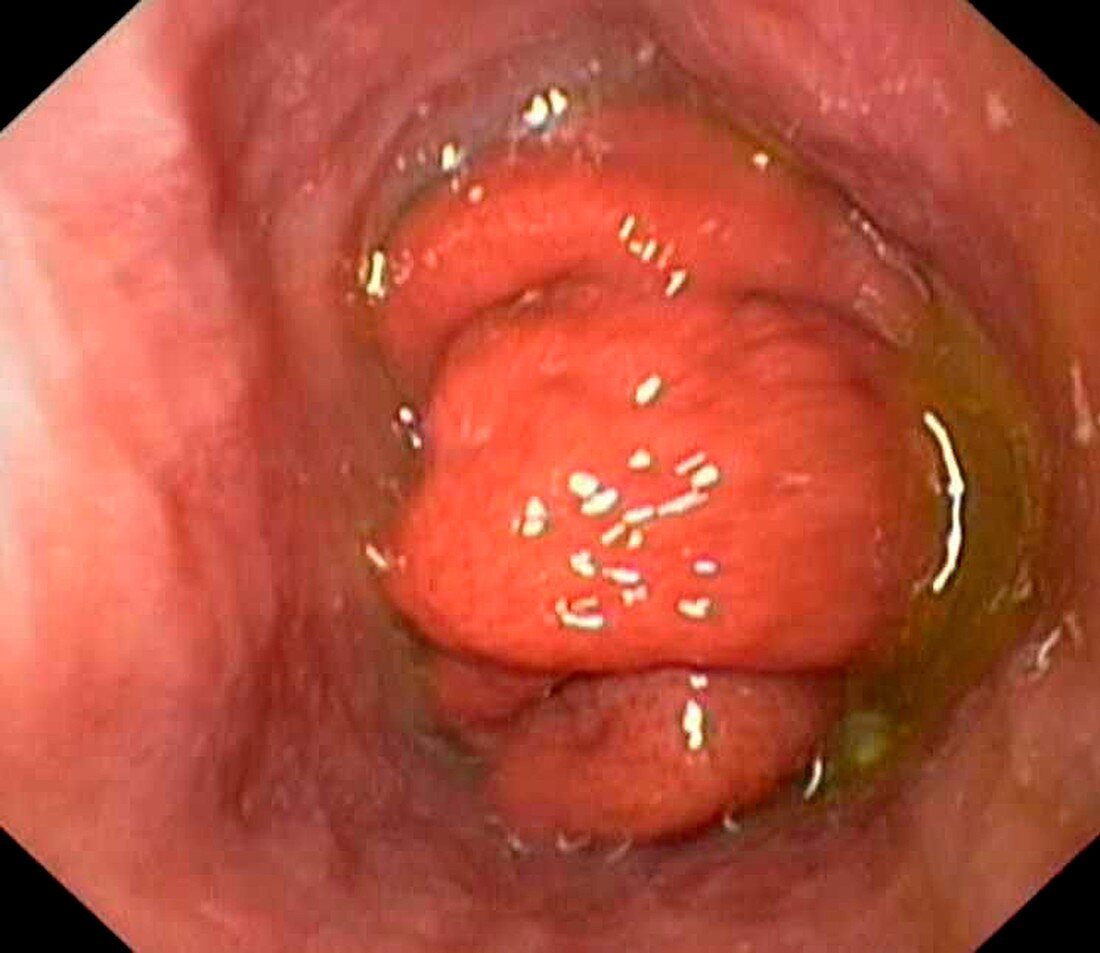 Gastro-oesophageal prolapse