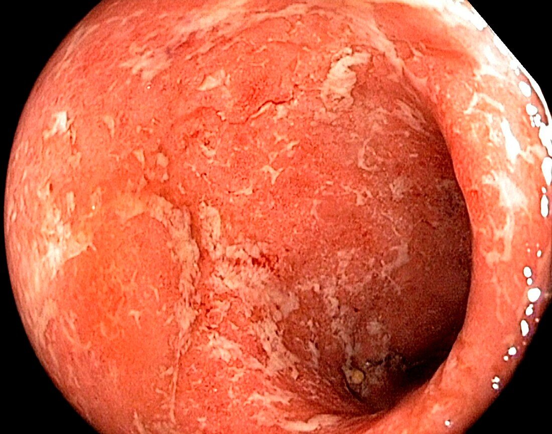 Ulcerative colitis in the rectum