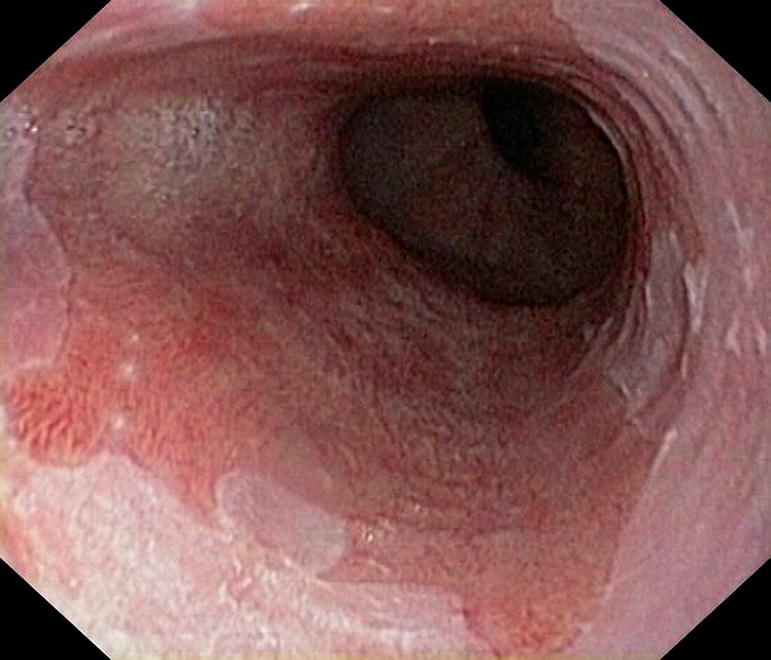 Barrett's oesophagus due to reflux
