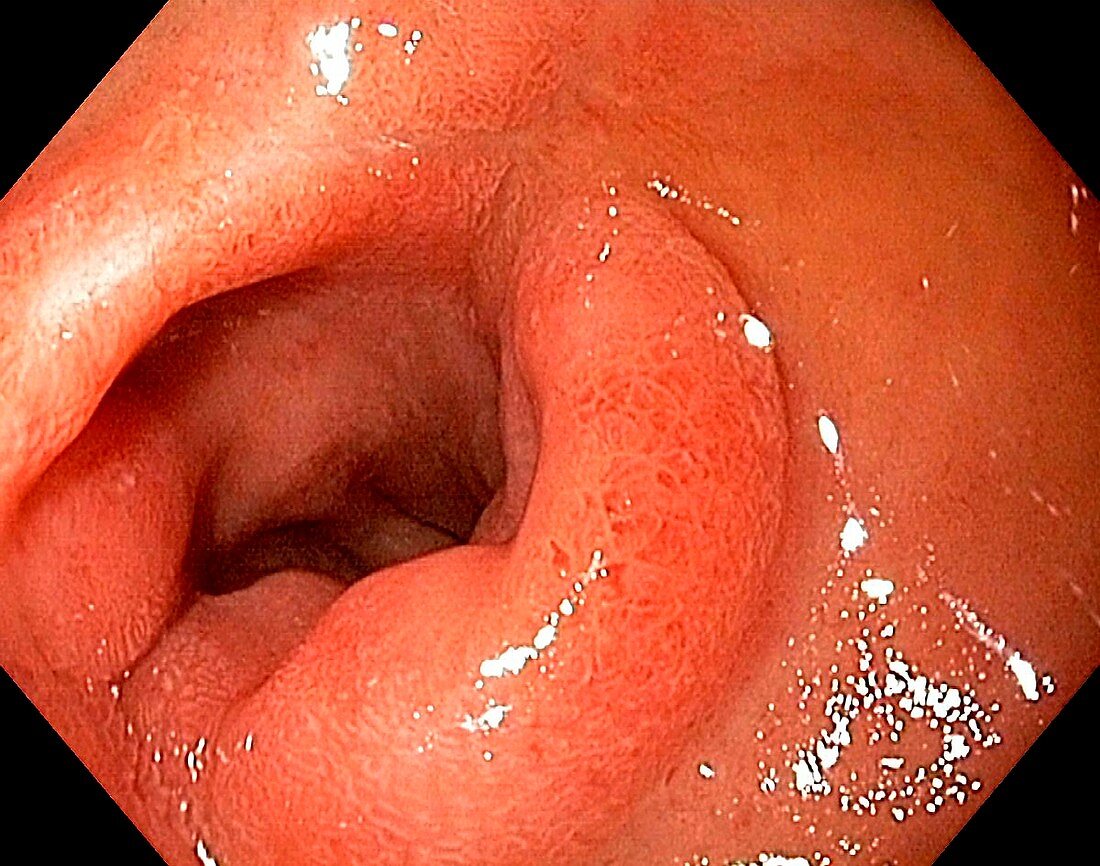 Scar from a duodenal ulcer