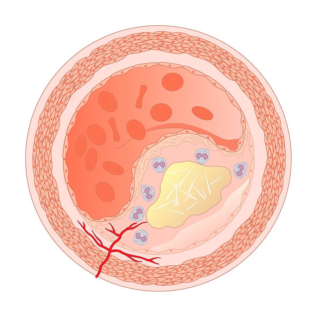 Narrowed blood vessel,artwork