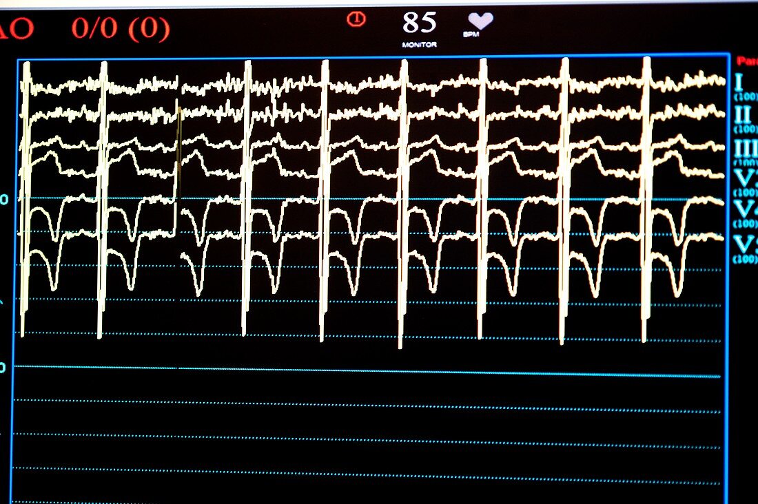 Electrocardigram