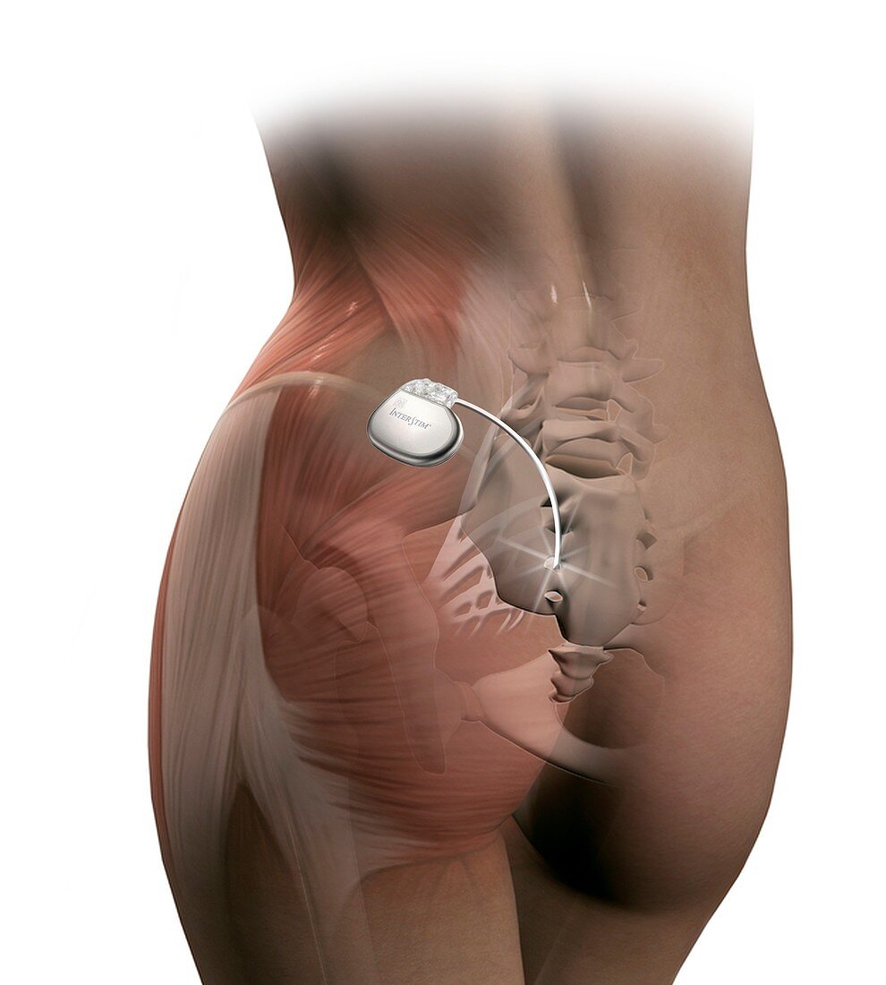 Sacral nerve stimulation implant,artwork