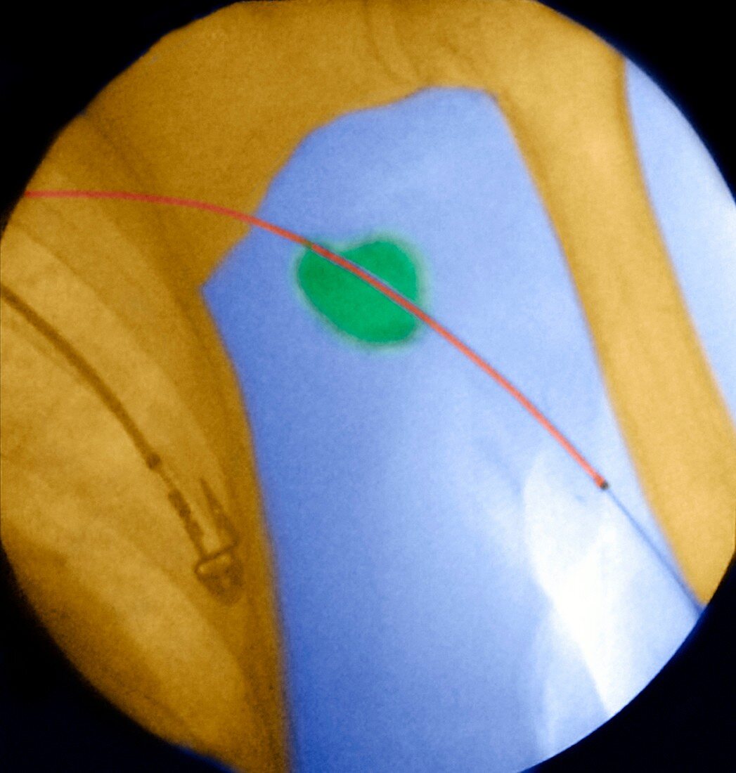 Balloon angioplasty,coloured X-ray