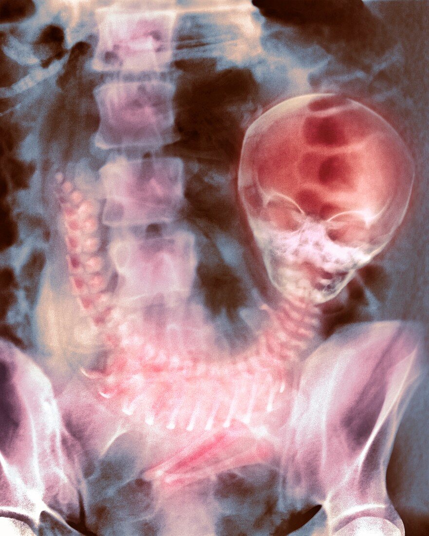 Full-term foetus,X-ray