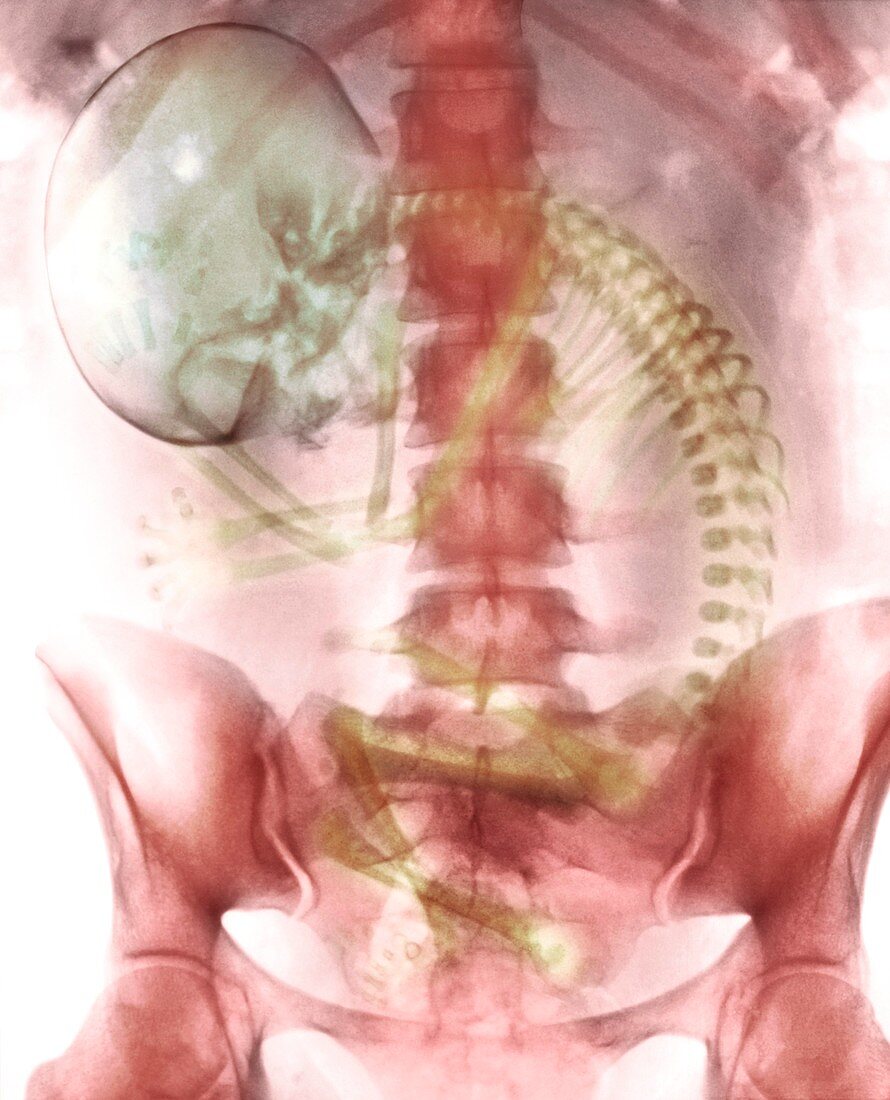 Full-term foetus,X-ray