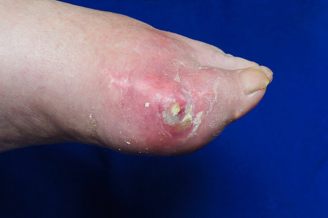 Gout of the foot with ulceration