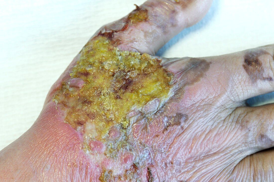 Infected burn on the hand