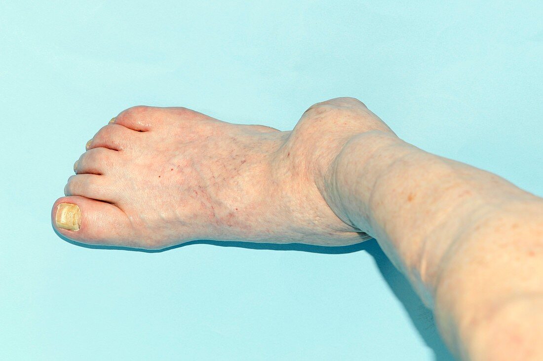 Arthritic ankle in Charcot's disease