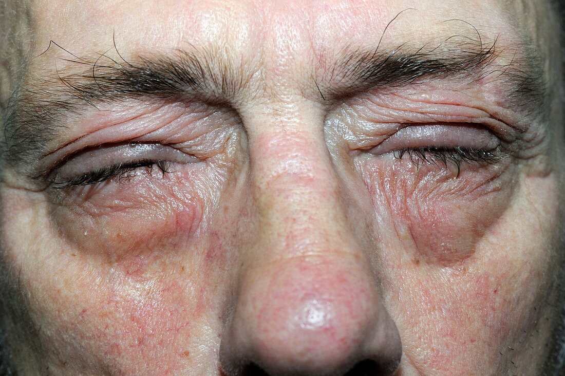 Conjunctivitis of the eyes