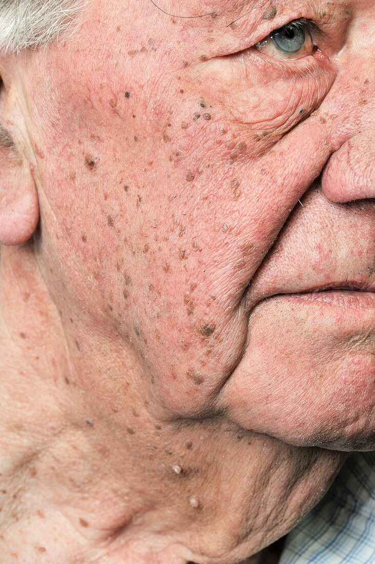 Seborrhoeic warts on the face