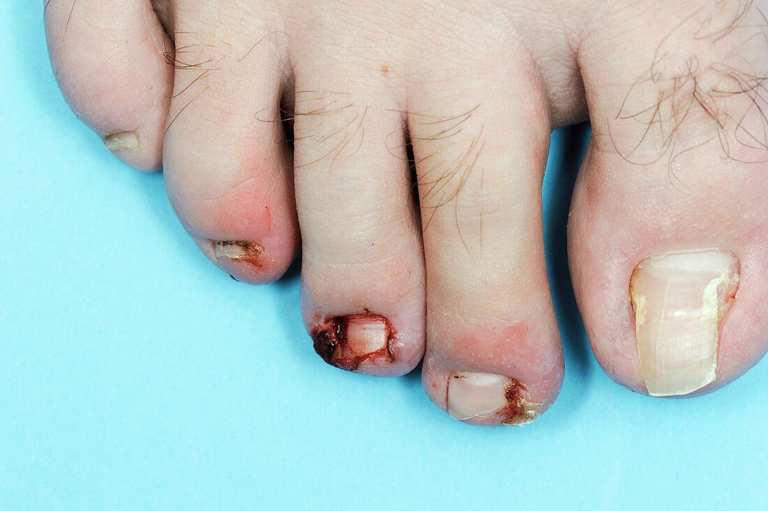 Infected toenails of the foot