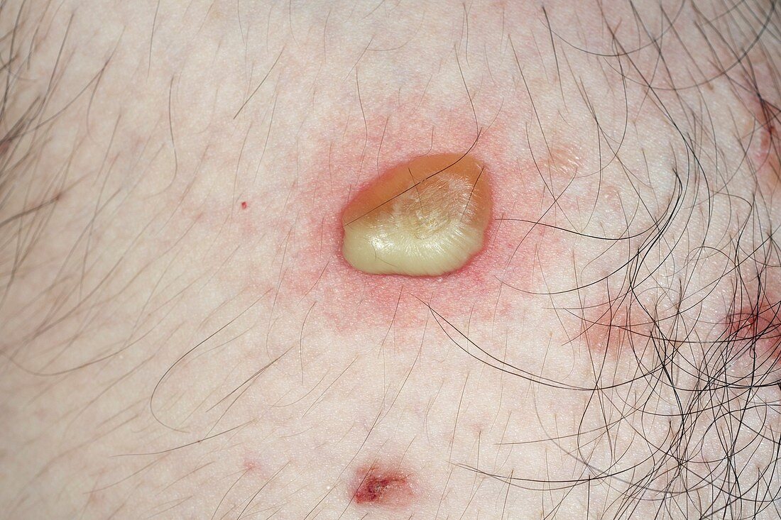 Infected pemphigus sore on the skin