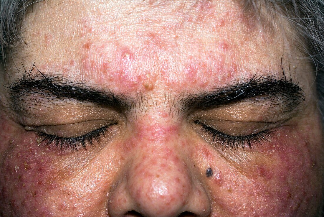 Acne rosacea on the face in a woman