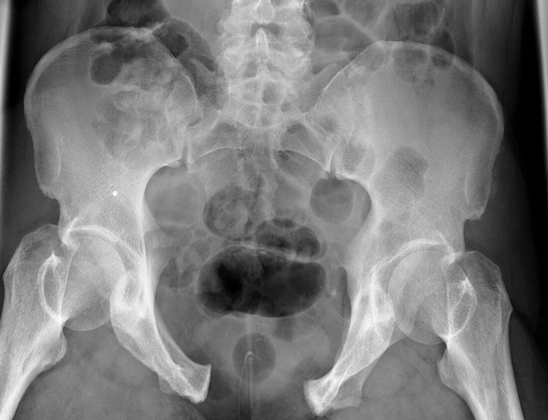 Pelvic fracture,X-ray