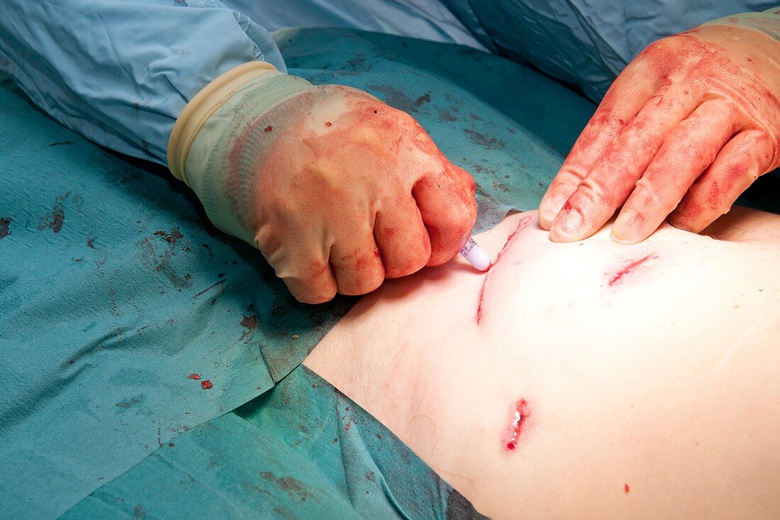 Sealing keyhole surgery incisions