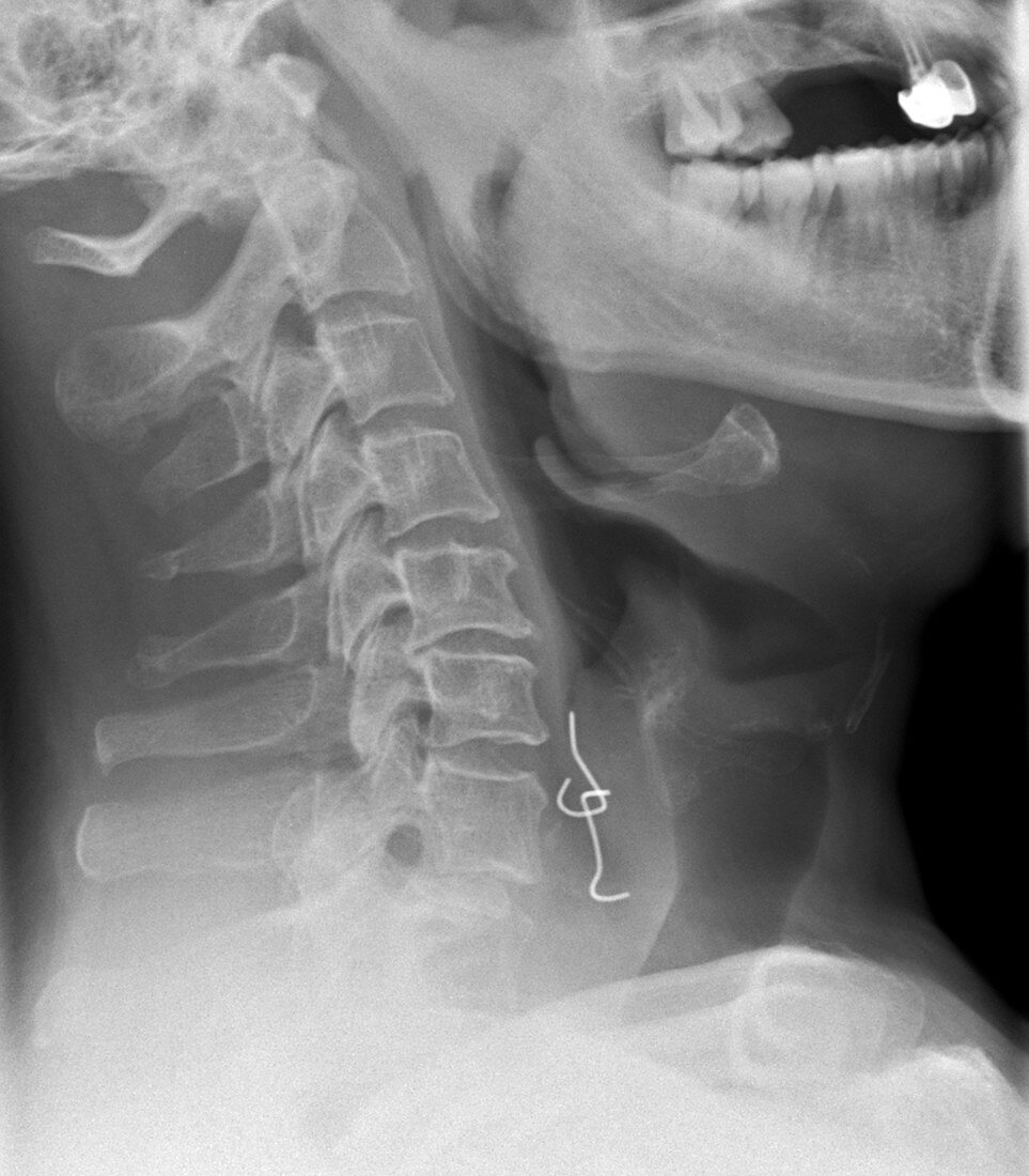 Swallowed denture,X-ray