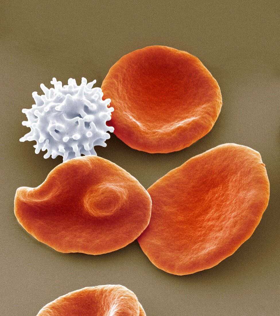 Healthy and crenated red blood cells,SEM