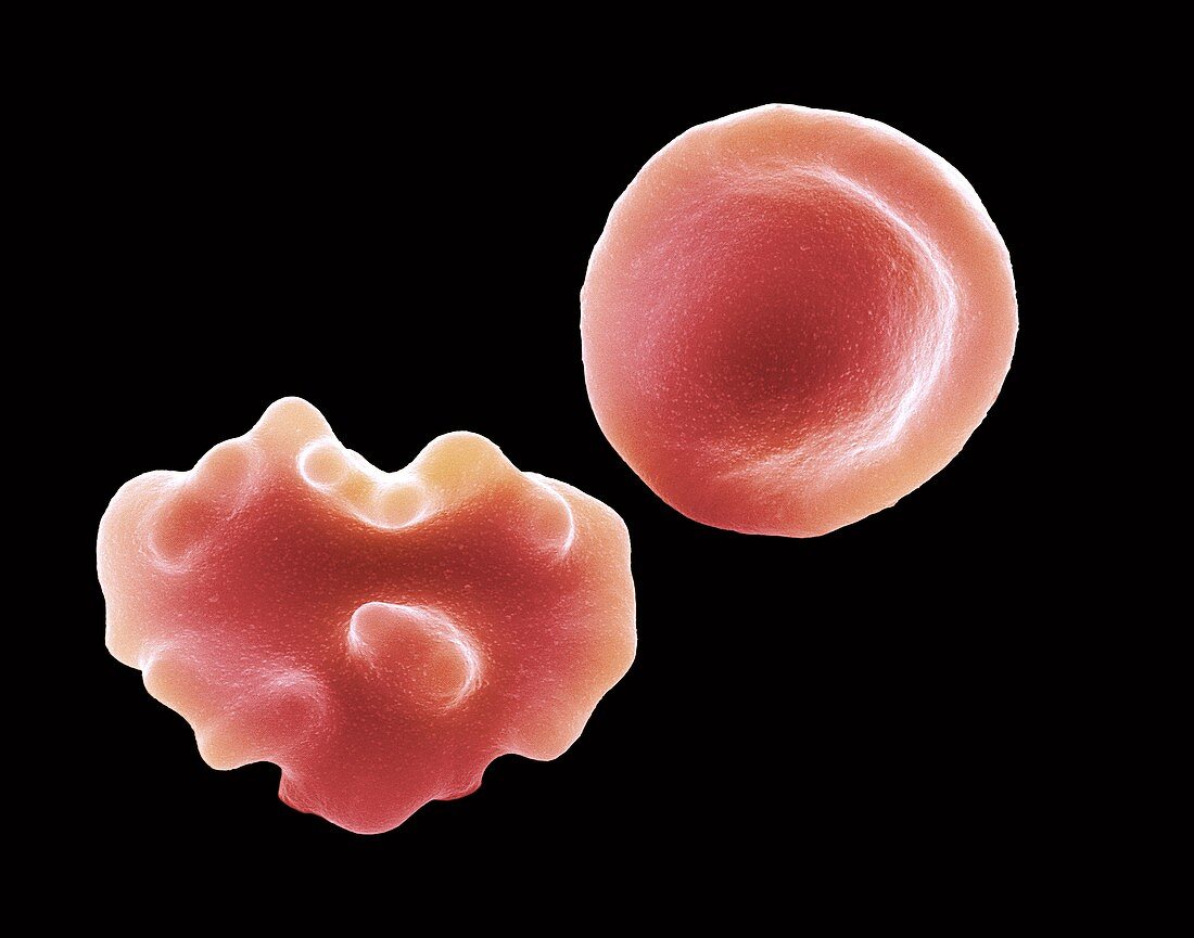 Healthy and crenated red blood cells,SEM