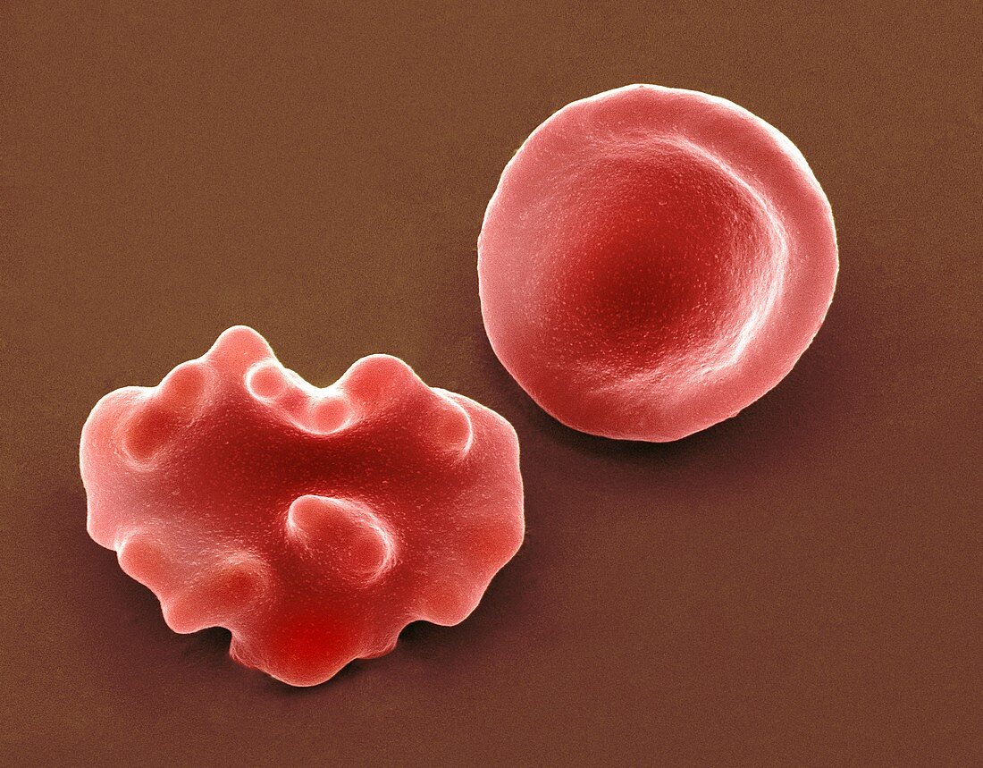 Healthy and crenated red blood cells,SEM