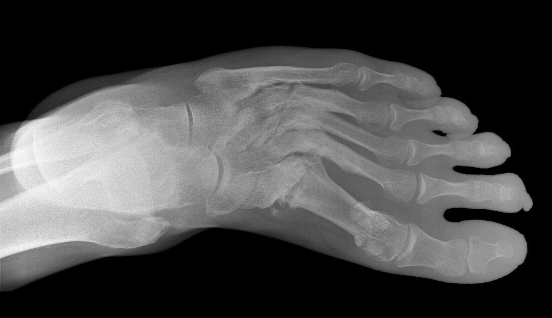 Lisfranc fracture,X-ray