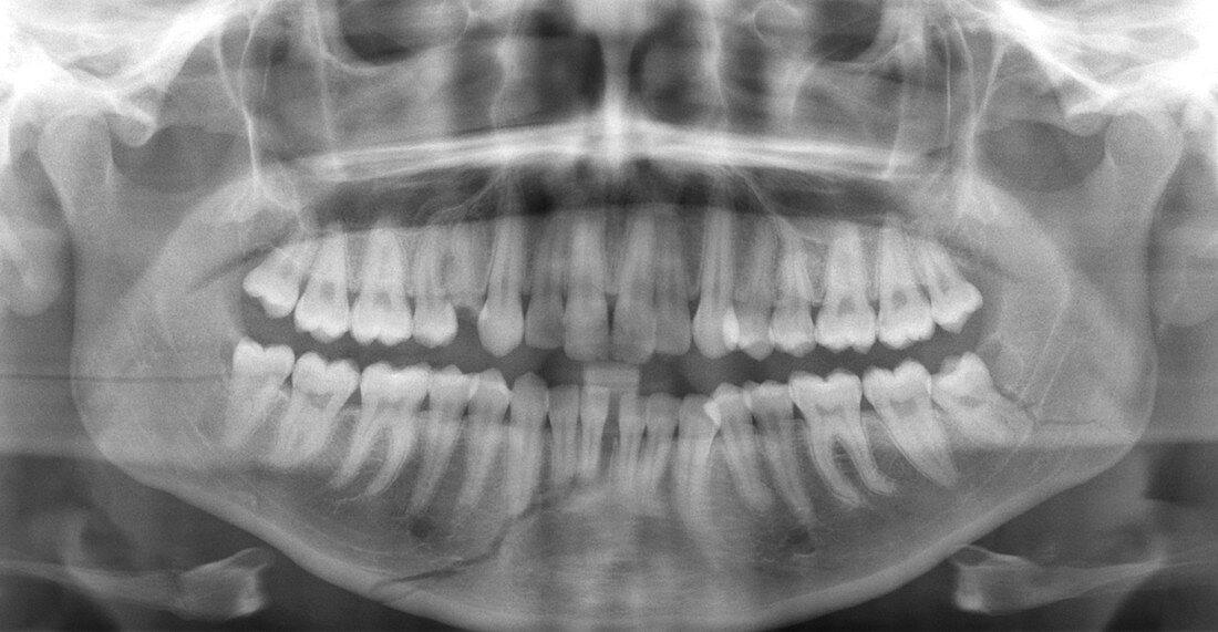 Broken jawbone,X-ray