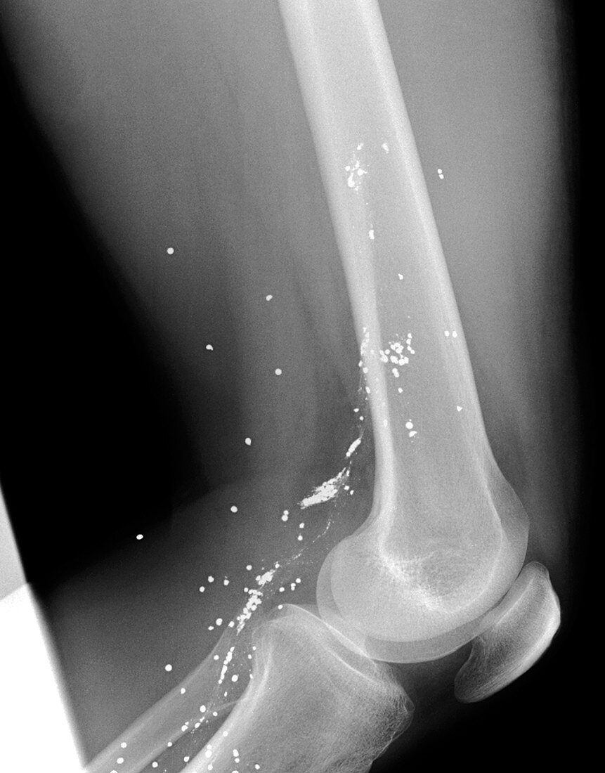Shrapnel injury,X-ray