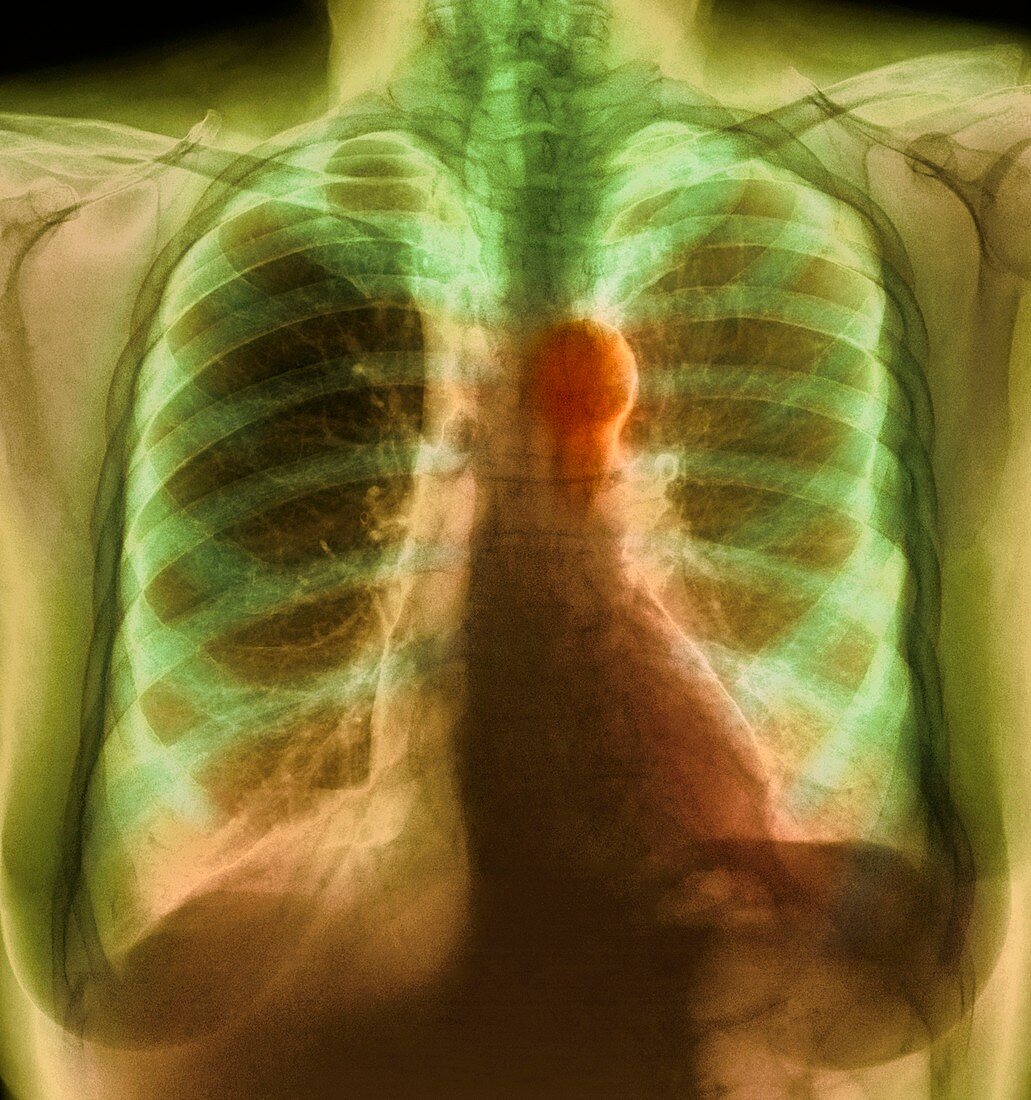 Aortic aneurysm,X-ray