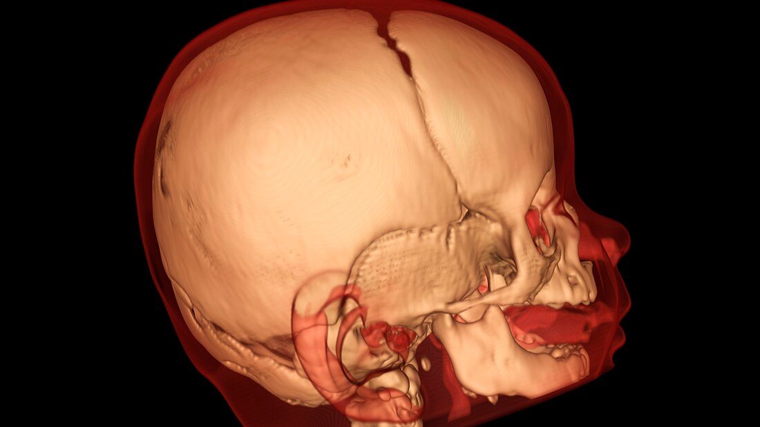 Child's skull,3D CT scan