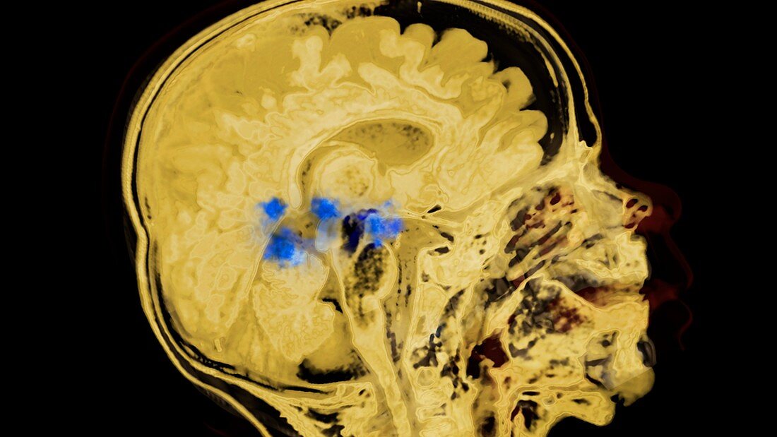 Child's brain activity,MRI scan