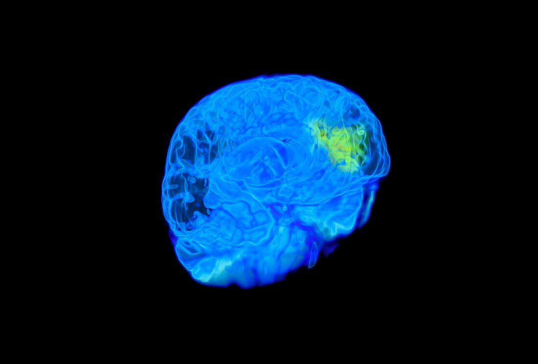 Child's brain activity,MRI scan