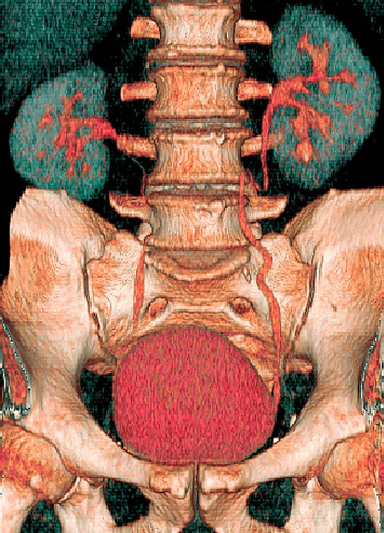 Kidneys and bladder,3D CT scan