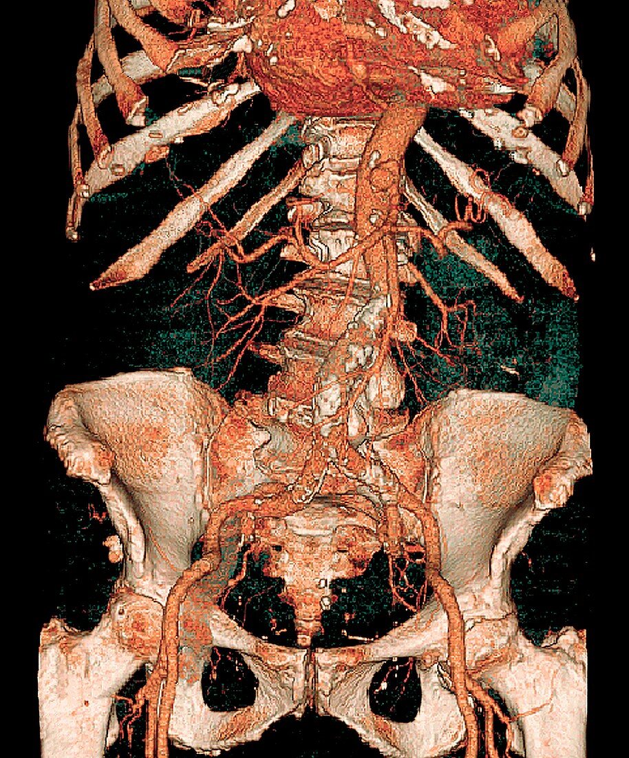 Calcified aortic artery,3D CT scan