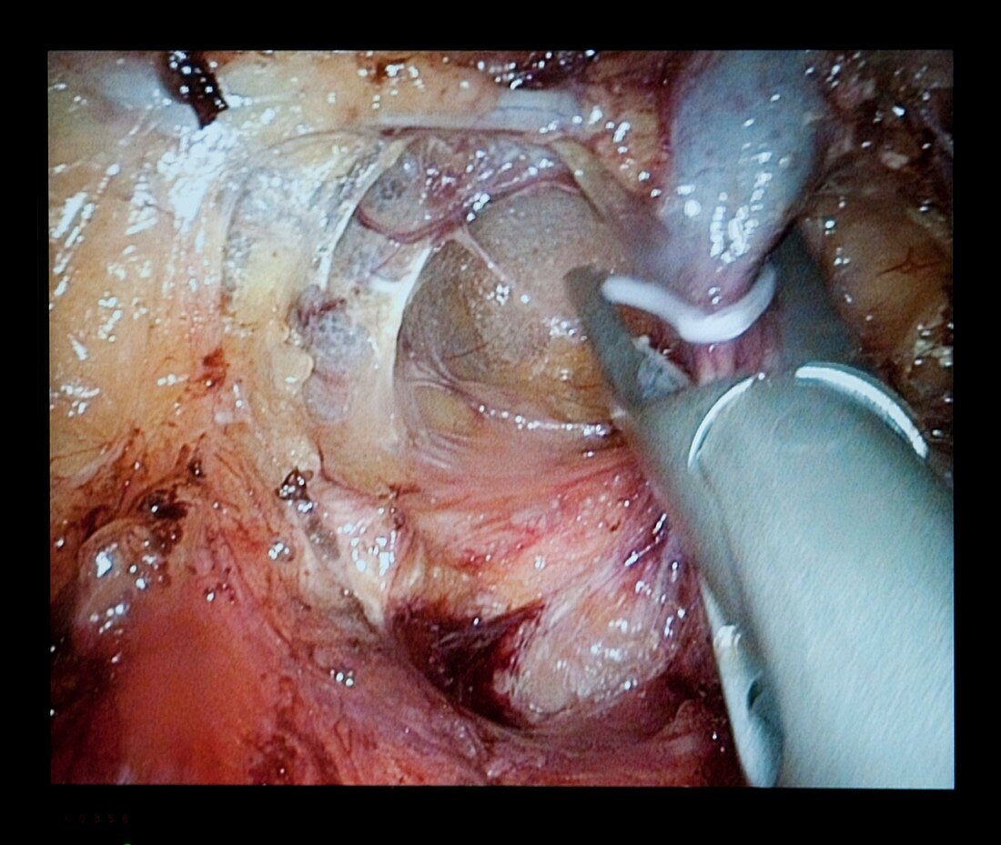 Keyhole kidney removal surgery