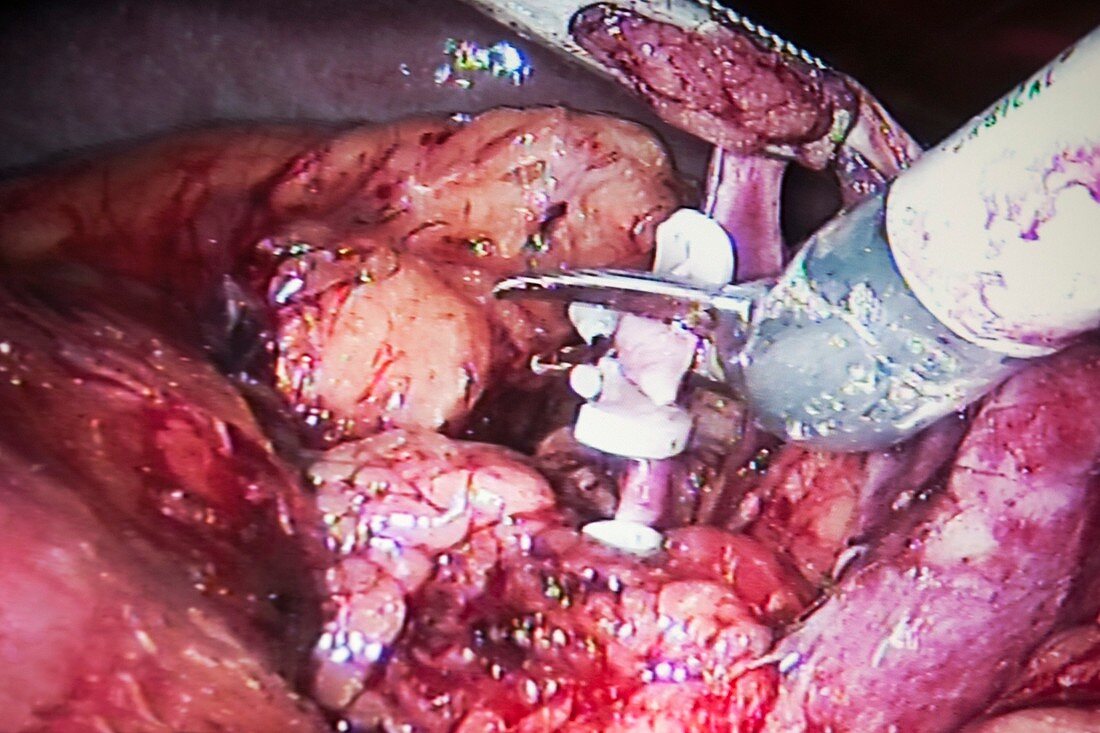 Robotic kidney removal surgery