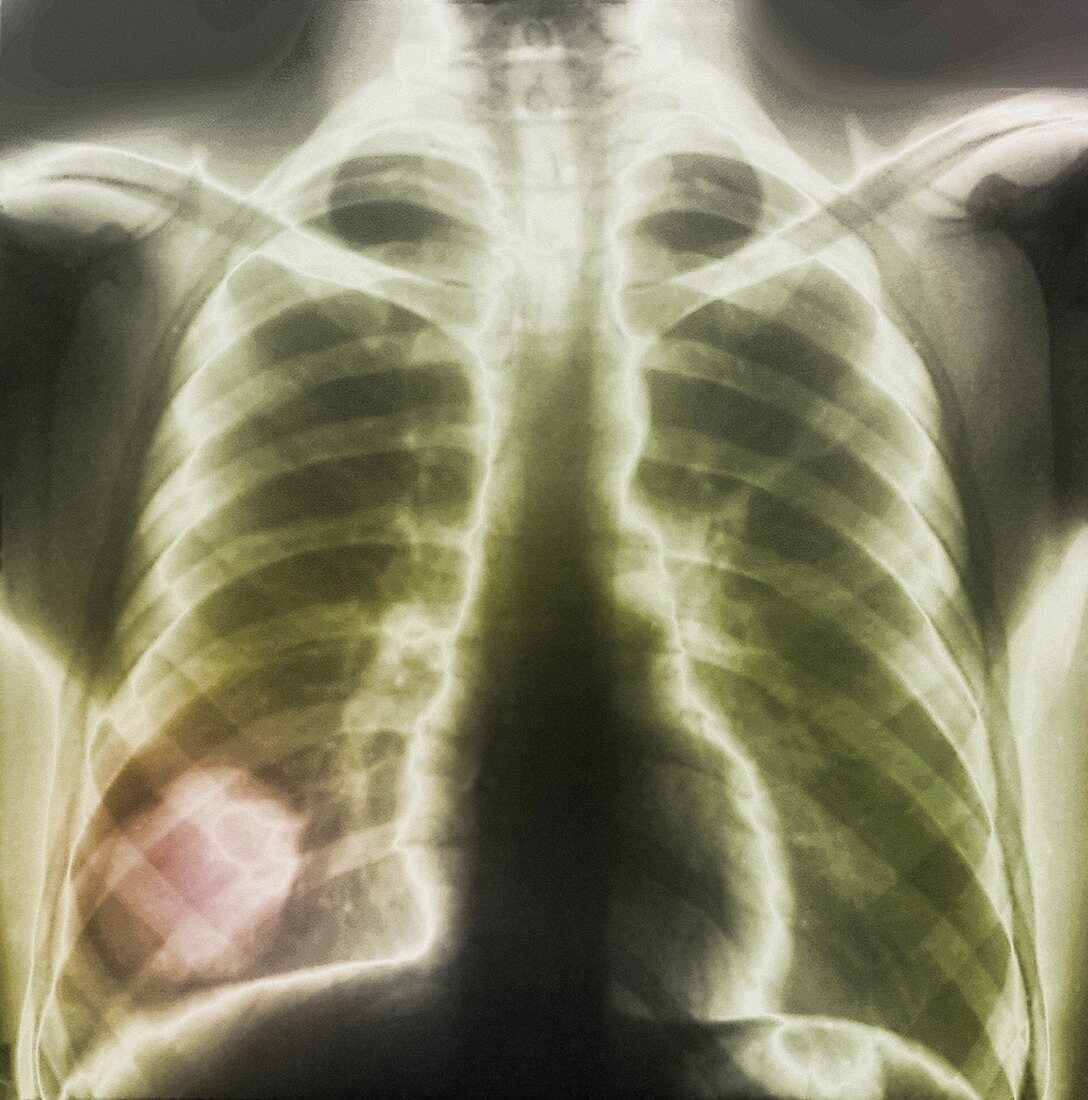 Pulmonary tapeworm cysts,X-ray