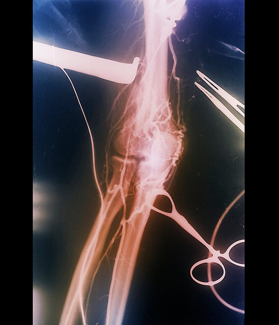 Arterial thrombosis removal,X-ray