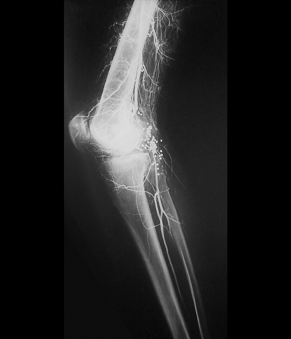 Arterial thrombosis removal,X-ray