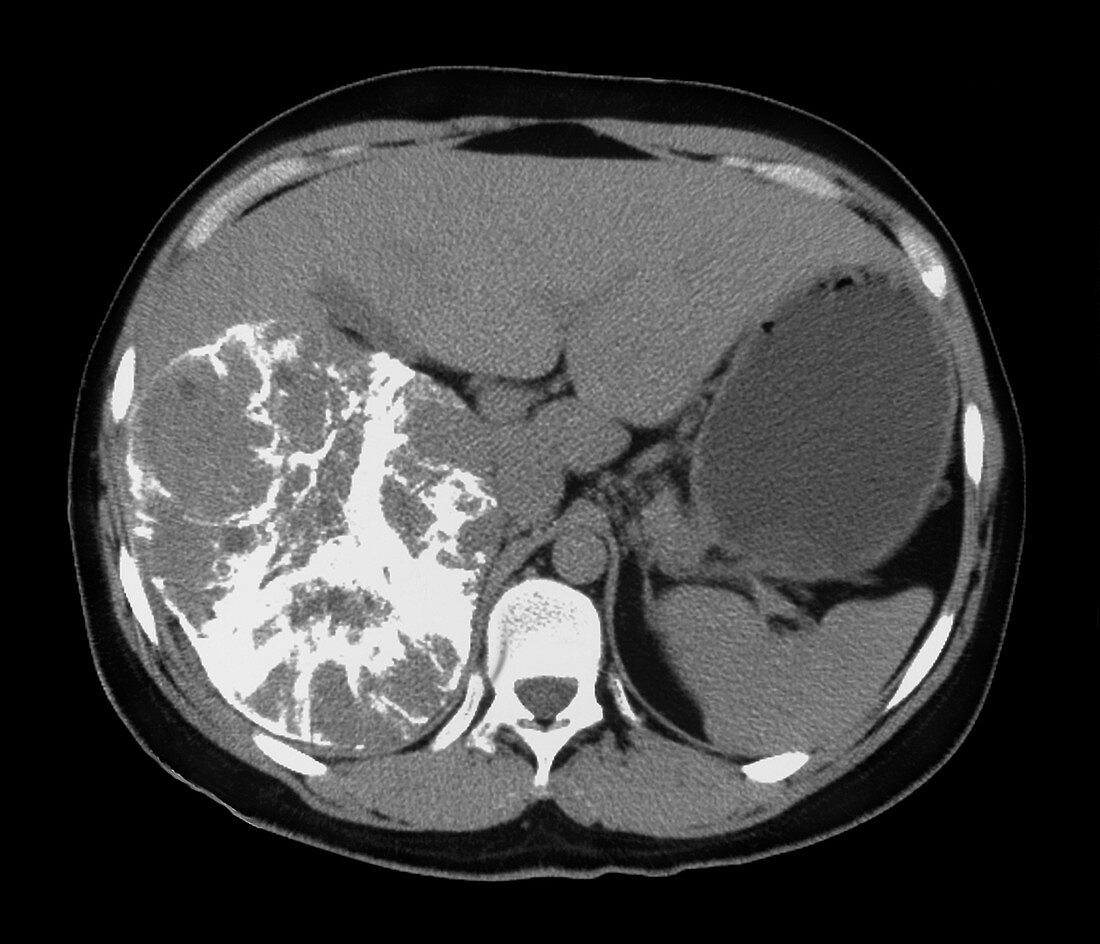 Liver cancer,CT scan