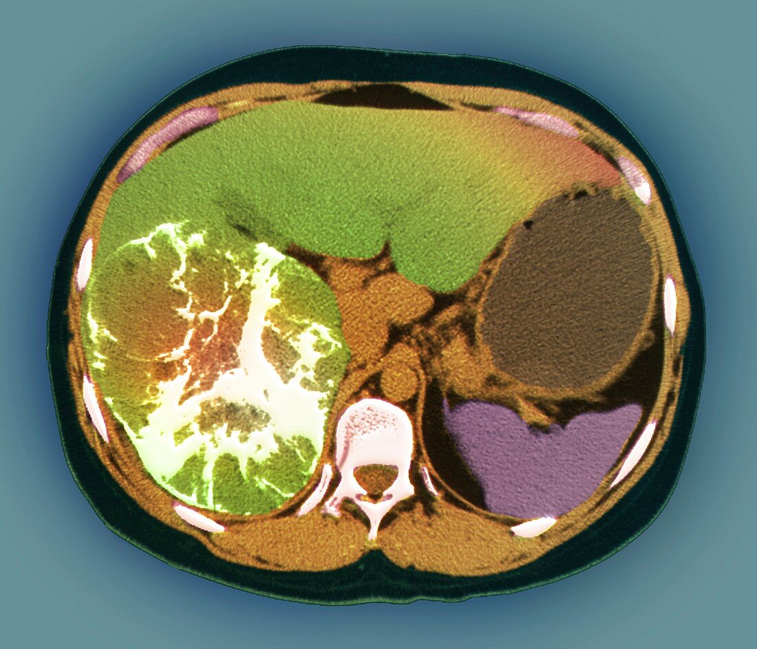 Liver cancer,CT scan
