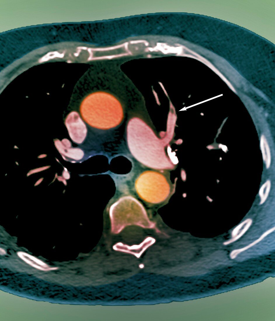 Pulmonary embolism,CT scan