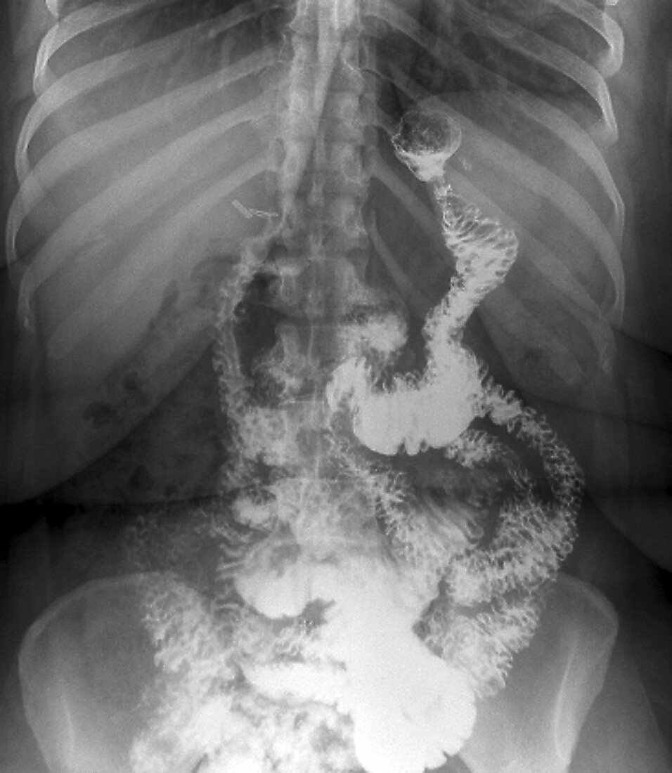 Gastric bypass surgery,X-ray