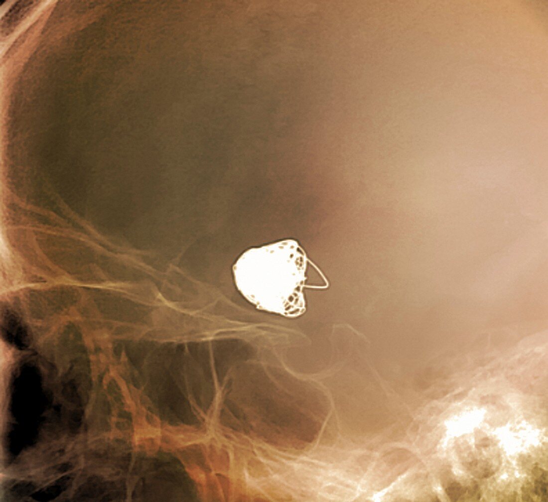 Treated intracranial berry aneurysm X-ray