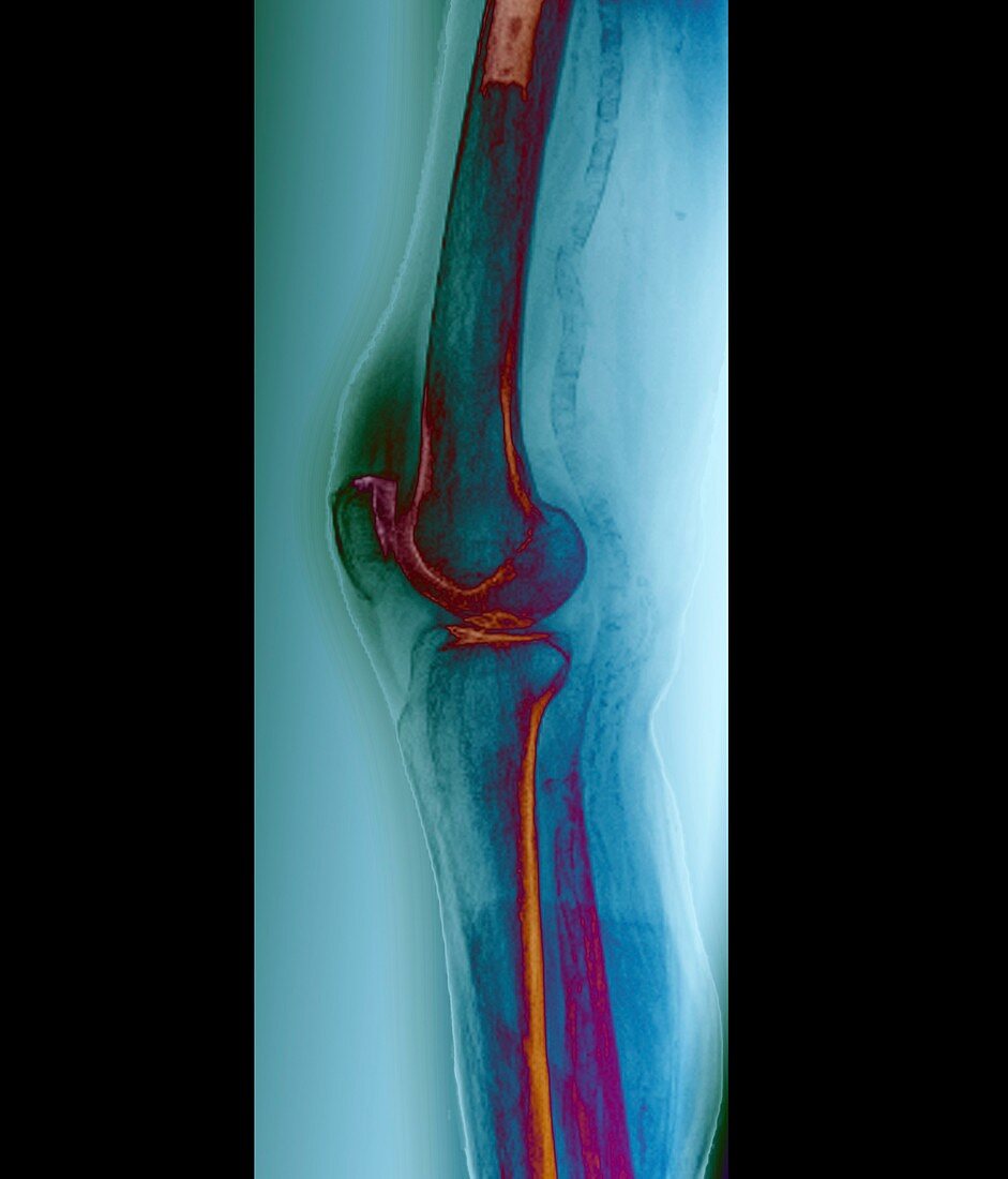 Arteritis of the knee,X-ray
