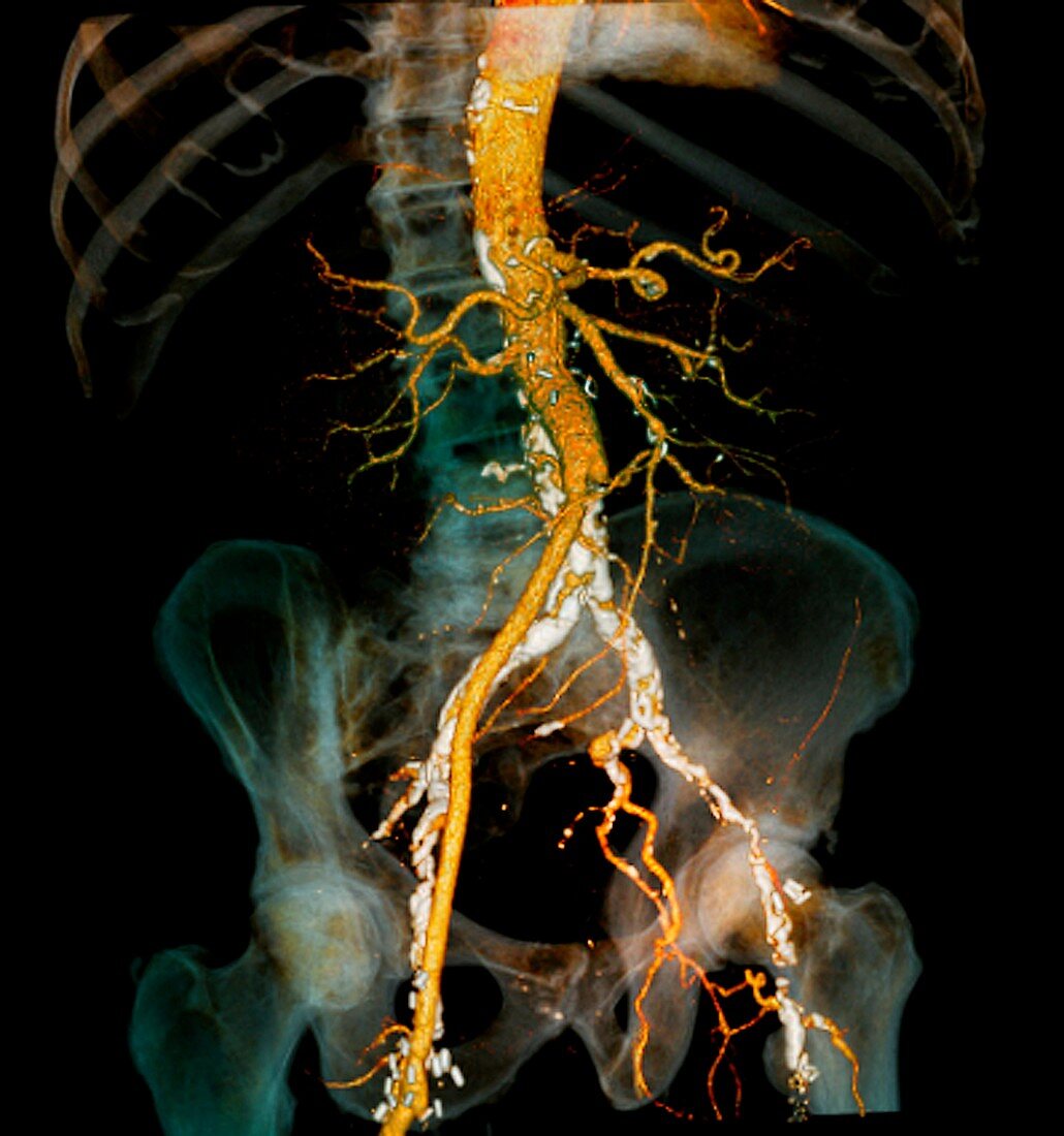 Arteritis,3d CT scan