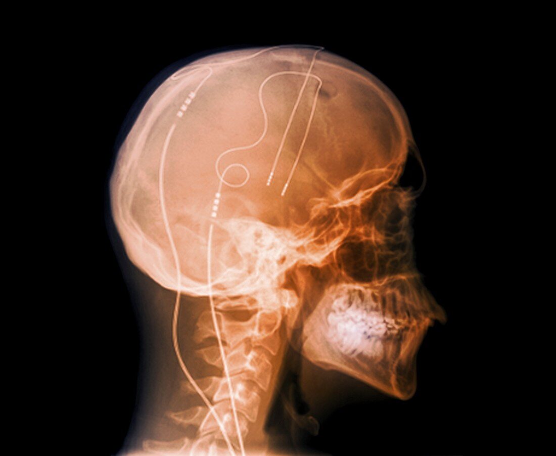 Tourette's treatment,X-ray