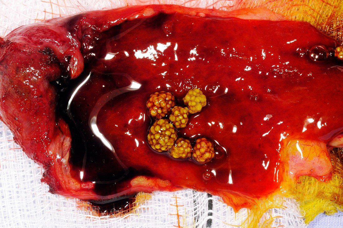 Excised gallbladder and gallstones