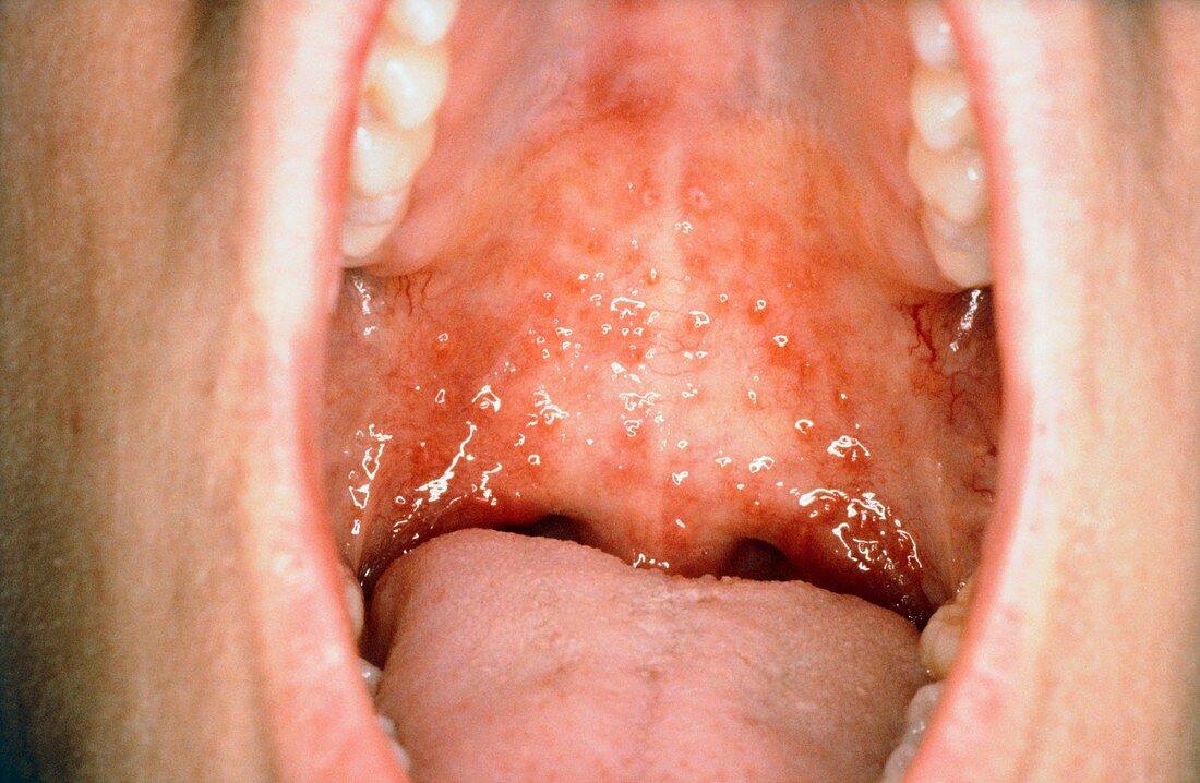 Oral herpes