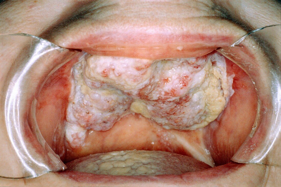Oral wart growths
