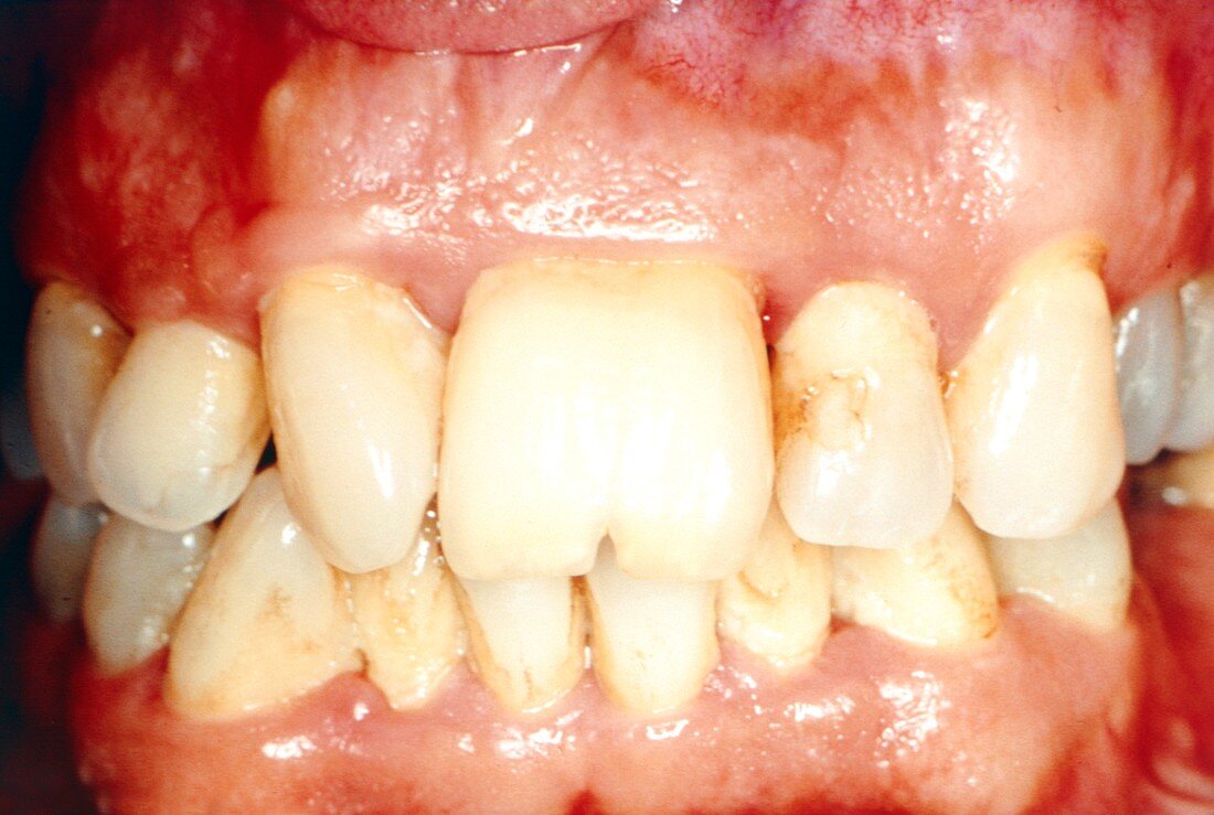 Abnormal incisors
